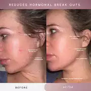 Sensse Professional LED Light Therapy Facial Mask