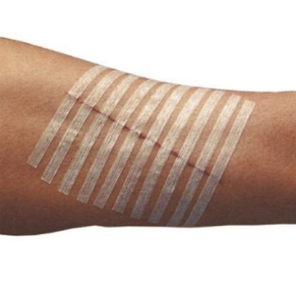 Sterile Wound Closure Strips