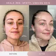 Sensse Professional LED Light Therapy Facial Mask