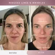Sensse Professional LED Light Therapy Facial Mask