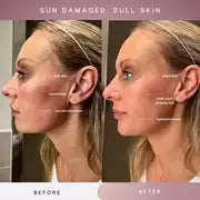 Sensse Professional LED Light Therapy Facial Mask